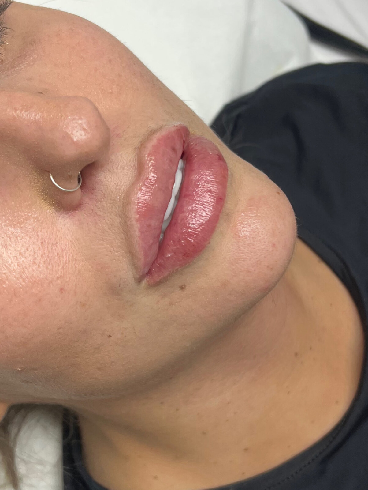 Lip filler