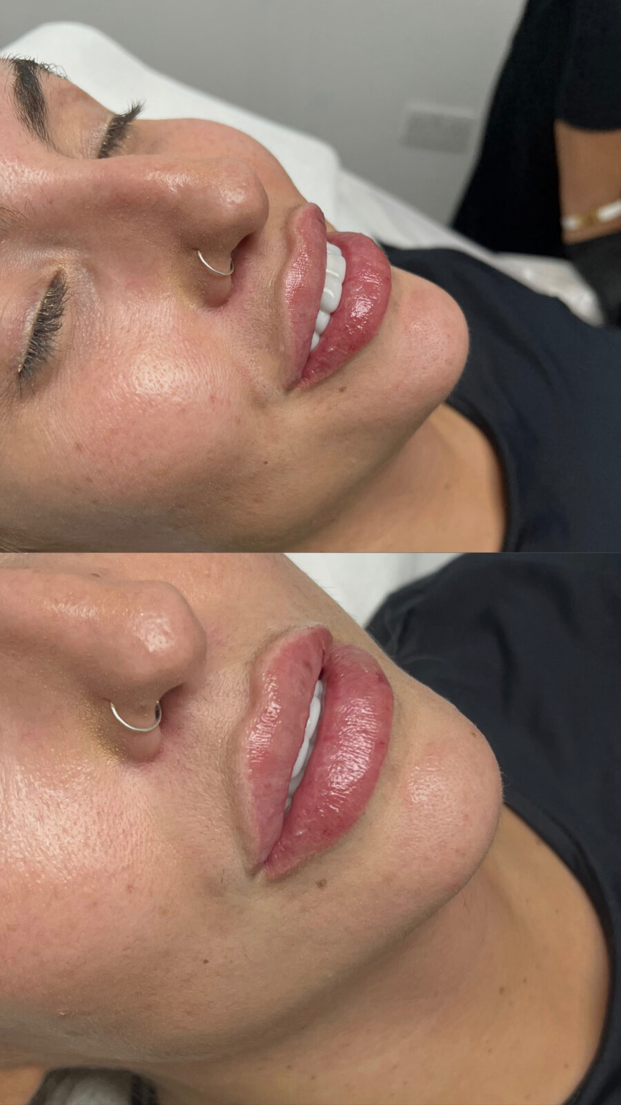 Lip filler