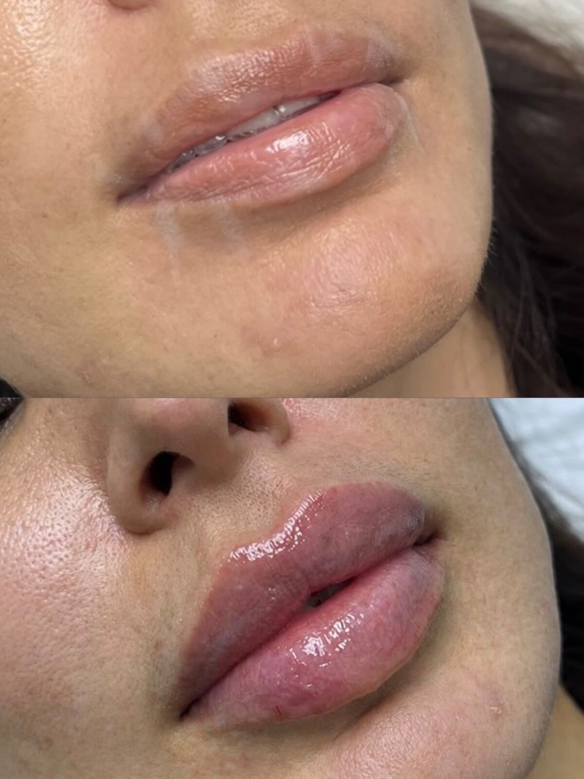 Lip filler result