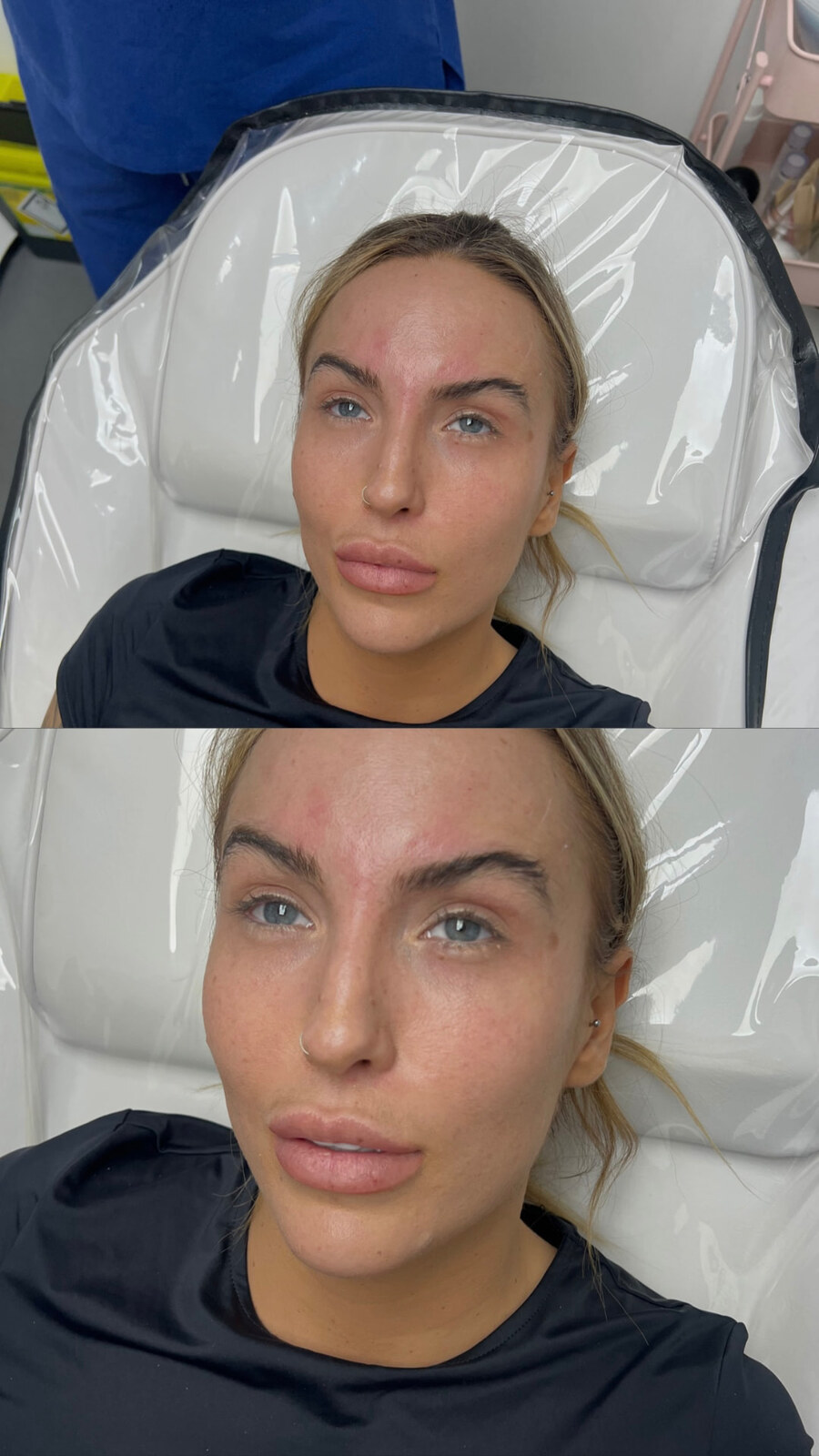 Anti-wrinkle